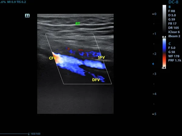 Color Doppler 2