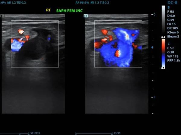 Color Doppler 3