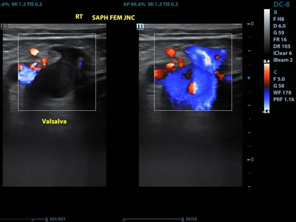 Color Doppler 4