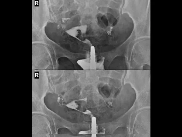 Contrast Procedures 2